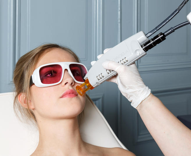 epilation laser visage