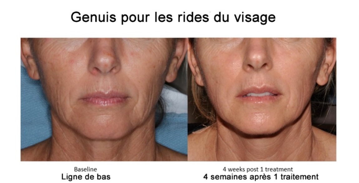  avant et apret laser genuis
