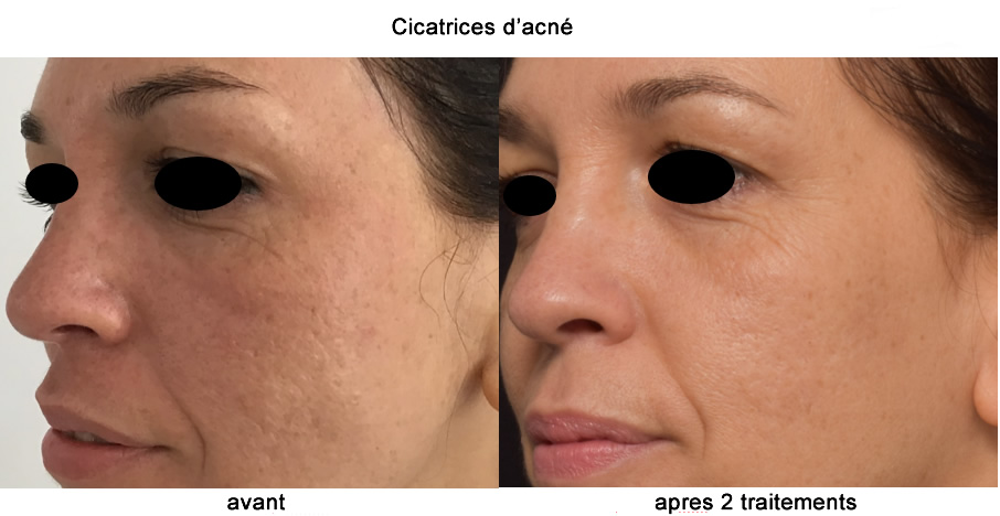  avant et apret laser genuis