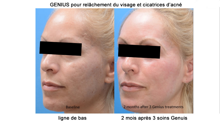  avant et apret laser genuis