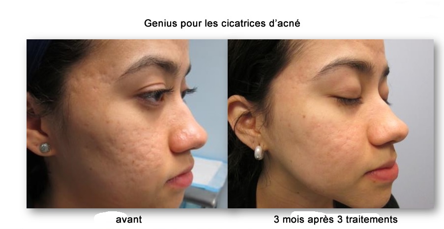 avant et apret laser genuis